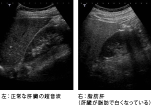 左：正常な肝臓の超音波、右：脂肪肝（肝臓が脂肪で白くなっている）