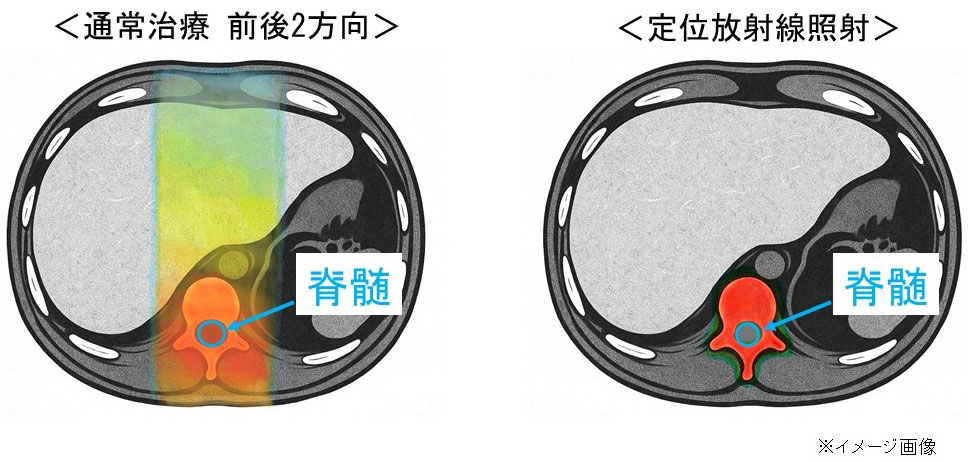 定位放射線照射