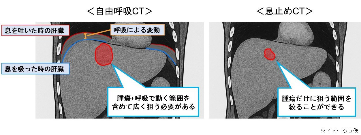 呼吸性移動対策