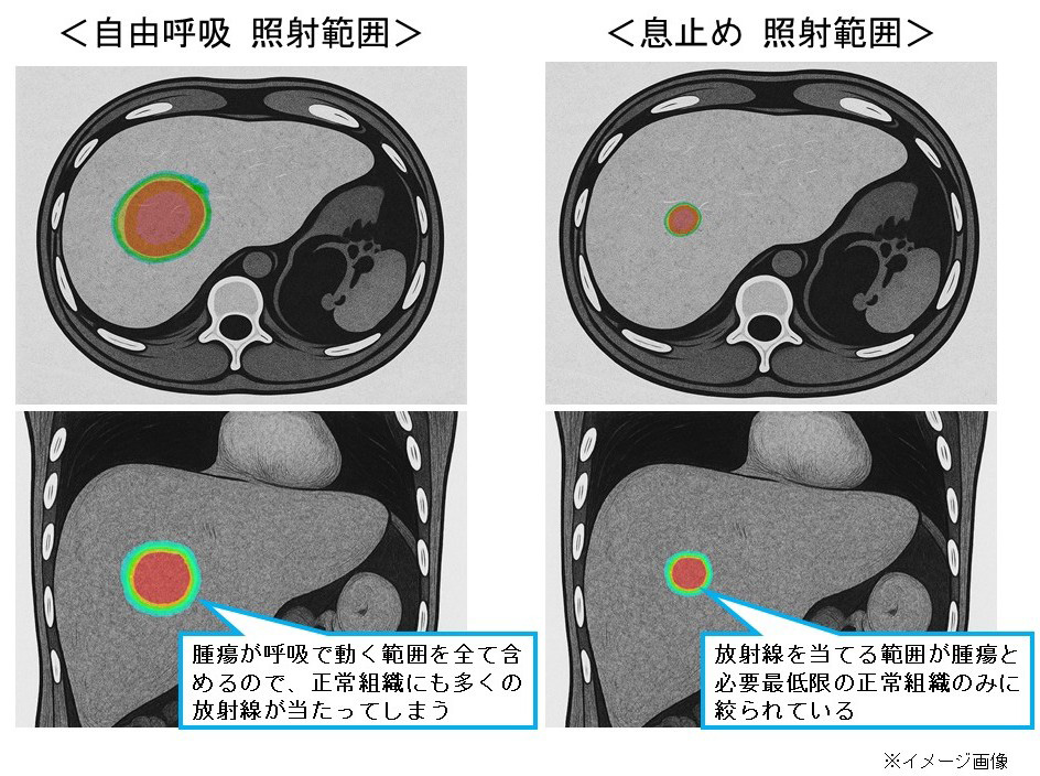 呼吸性移動対策