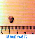 破砕前の結石