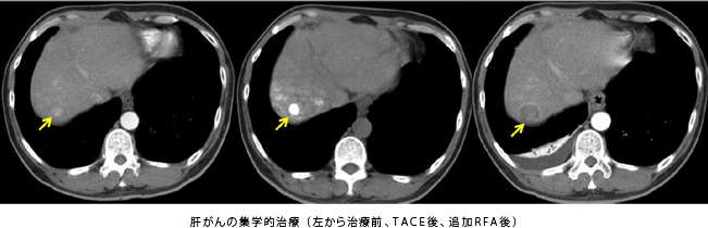 肝がんの集学的治療（左から治療前、TACE後、追加RFA後）